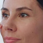 5 Areas That Can Benefit from Profhilo Treatment Beyond the Face