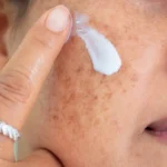 Melasma During Pregnancy Causes and Safe Treatment Options