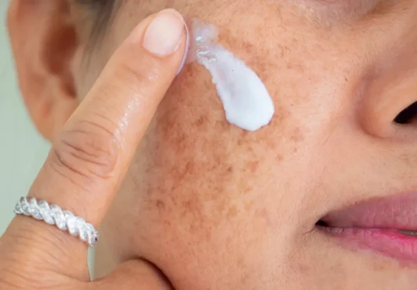 Melasma During Pregnancy Causes and Safe Treatment Options