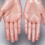 Living With Severe Hyperhidrosis: How Sweaty Palms Surgery Singapore Can Help