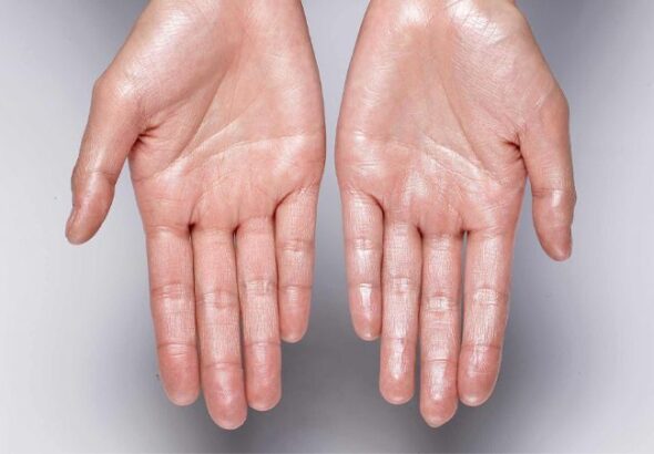 Living With Severe Hyperhidrosis: How Sweaty Palms Surgery Singapore Can Help
