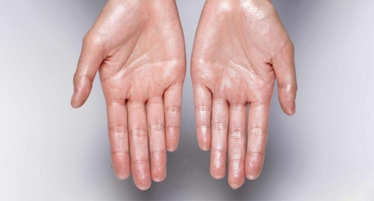 Living With Severe Hyperhidrosis: How Sweaty Palms Surgery Singapore Can Help