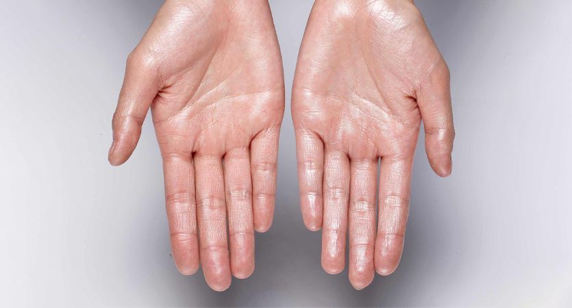 Living With Severe Hyperhidrosis: How Sweaty Palms Surgery Singapore Can Help