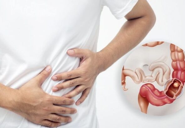 Colonoscopy Findings Explained: What Your Colon Specialist Singapore May Recommend Next
