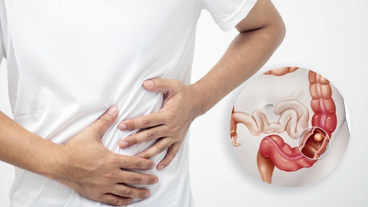 Colonoscopy Findings Explained: What Your Colon Specialist Singapore May Recommend Next